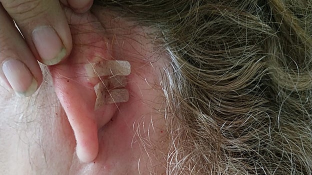 Puntos de aproximación en la oreja izquierda