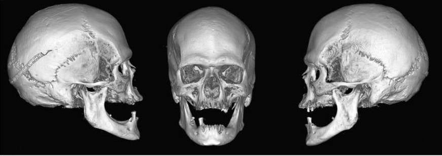  Vistas de los lados derecho, frontal e izquierdo de la reconstrucción en 3D del cráneo a partir de la tomografía