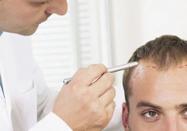 Solo médicos titulados podrán hacer implantes de pelo en Andalucía