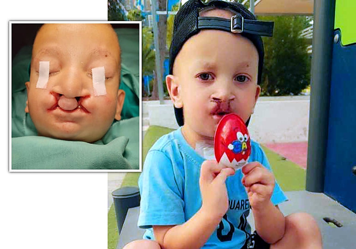 Imagen del pequeño Houdaifa antes y después de la operación