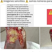 Despiden a la encargada de un bar que sufrió quemaduras graves: «No me preguntaron si podía caminar»