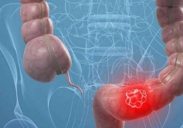 Castilla y León amplía a los 74 años el cribado de cáncer colonorrectal