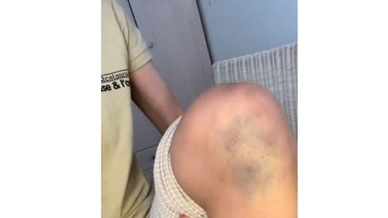 Hematoma en una rodilla que la trabajadora muestra como secuela de la paliza