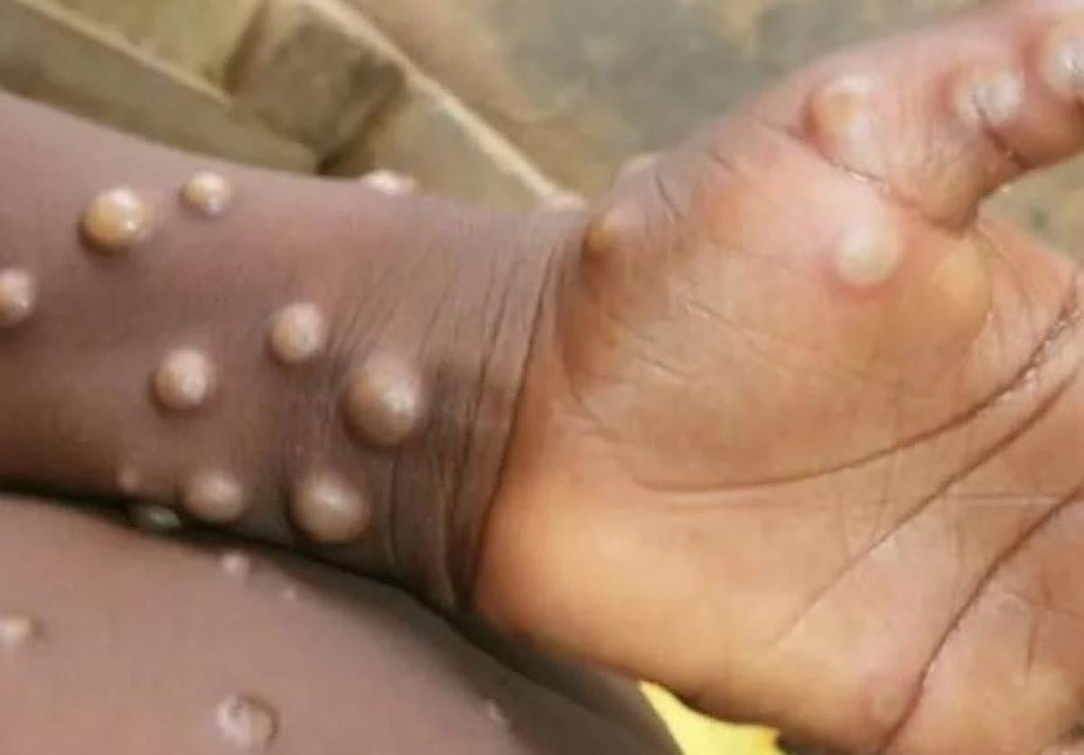 Un paciente con viruela del mono