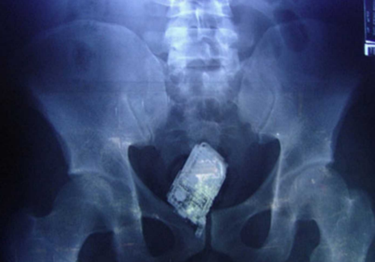 Imagen de una radiografía donde se ve un teléfono móvil que trató de introducir un preso en la cárcel