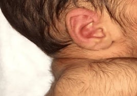 Imagen de un bebé con hípertricosis