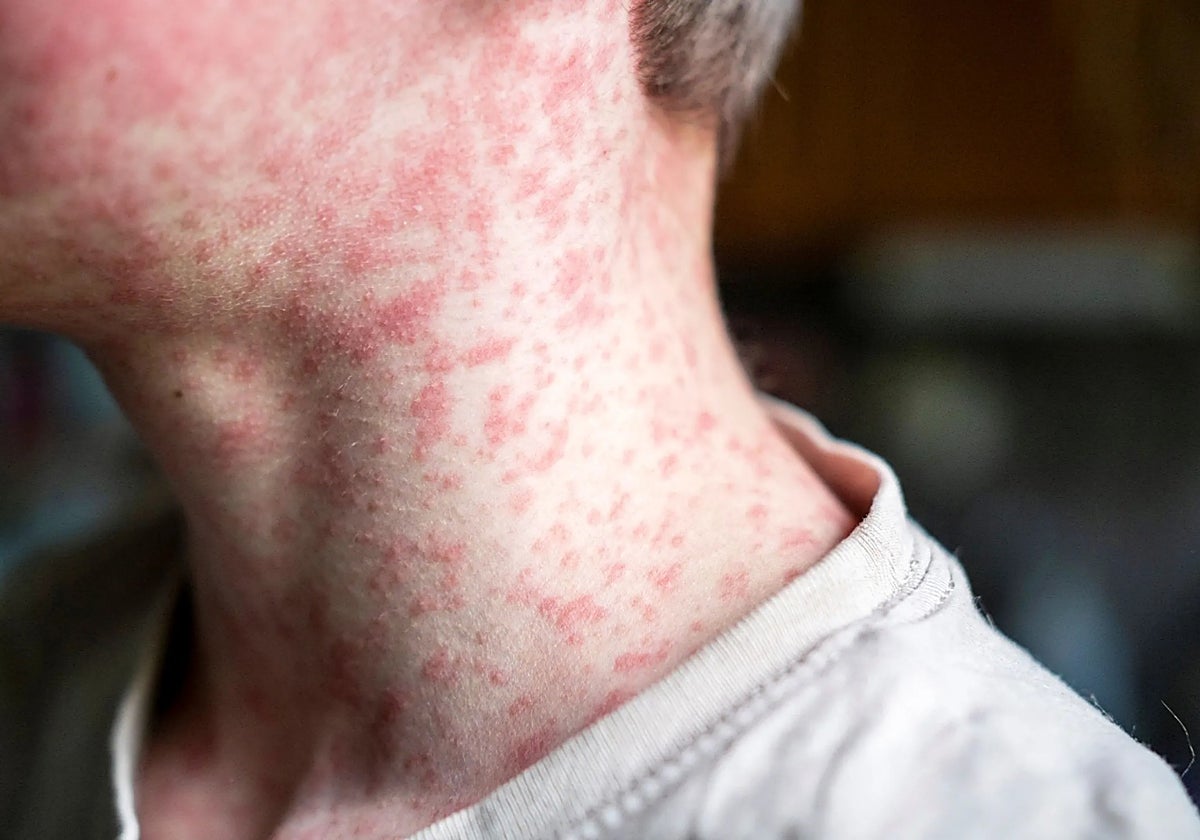 Una persona con sarampión