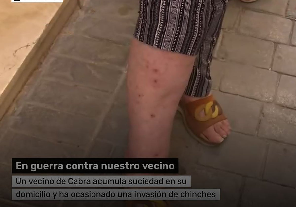 Una vecina muestra las picaduras de los insectos