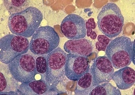 Galicia invierte 200 millones en fármacos CAR-T para pacientes con mieloma múltiple