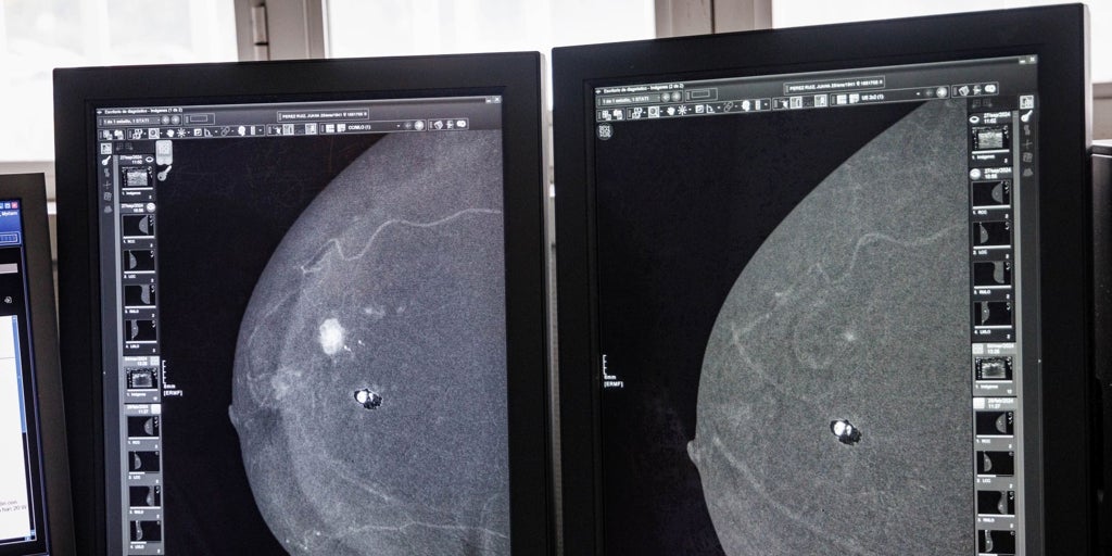 Sanidad fija servicios mínimos del 25% ante la huelga de técnicos de laboratorio, radiología y anatomía patológica en Castilla-La Mancha