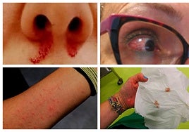 Cuando trabajar en el hospital de Toledo se convierte en problema de salud: «Llevo 11 sangrados nasales en un año»