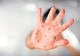 Los pediatras abogan por la 'captación activa' para mejorar la vacunación ante el sarampión