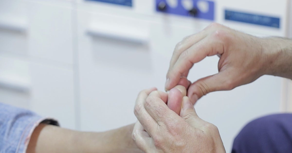 Un podólogo alerta sobre cómo evitar los  dedos en salchicha : «La elección del calzado es clave»