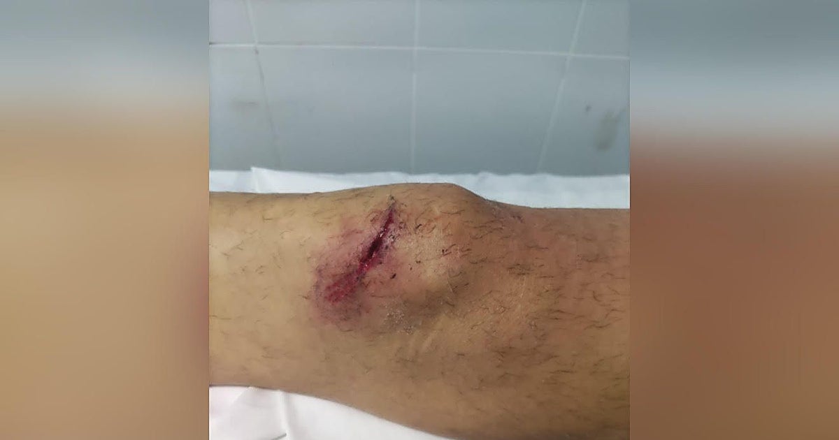Dejan sin indemnización a un policía que se fracturó la rótula al perseguir a un ladrón