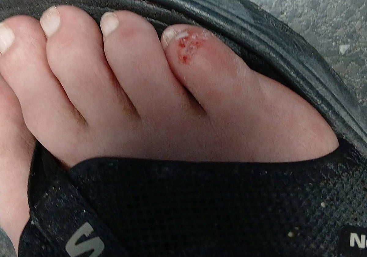 Antonio, mordido por una rata en un parque de Leganés: «Iba a la compra en chanclas y la pisé»