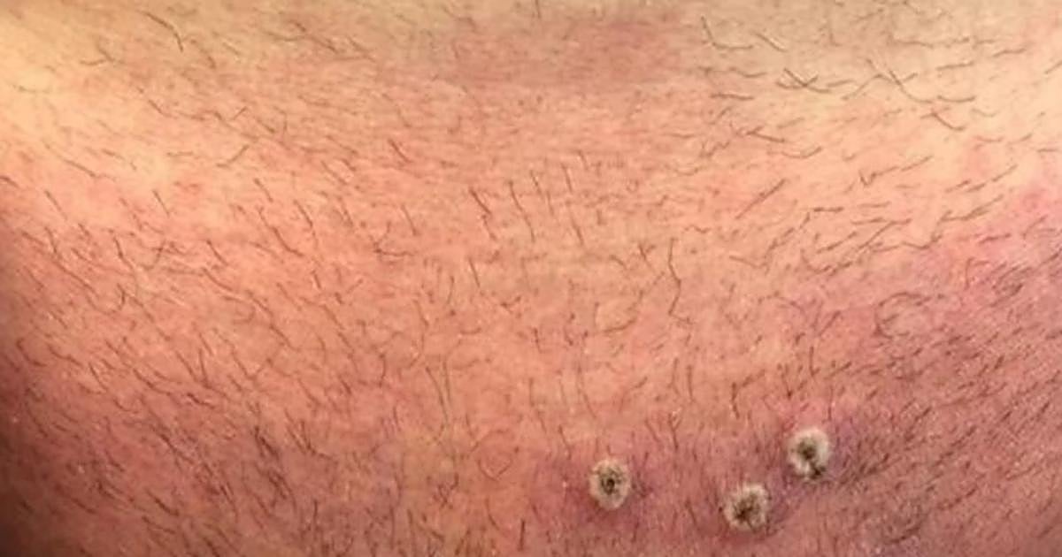Cantabria confirma un caso asintomático «aislado» de viruela del mono