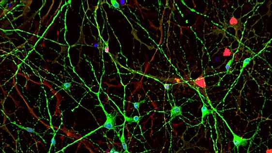 Una investigación descubre un nuevo mecanismo del Alzheimer por una proteína
