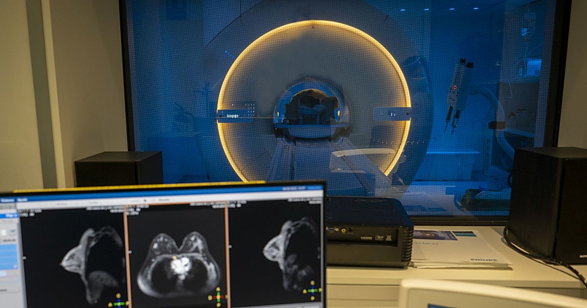 Galicia adelanta los cribados en cáncer de mama a los 45 años