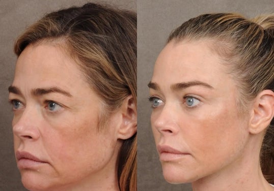 Denise Richards, antes y después de su levantamiento.