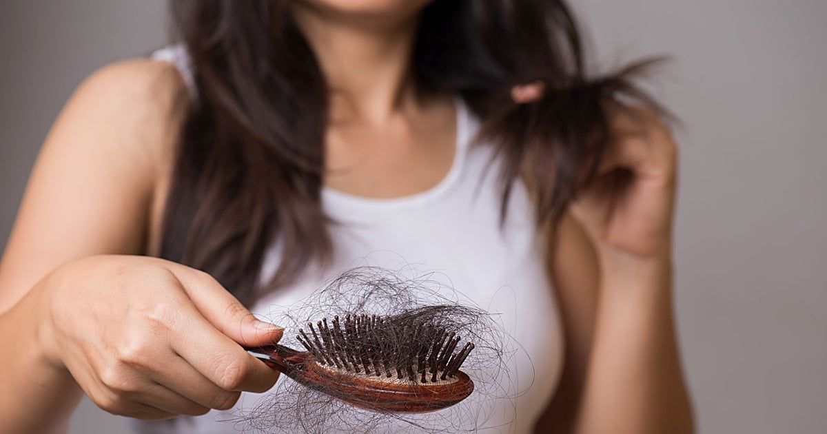 La caída del pelo, la gran obsesión estética de hombres y mujeres