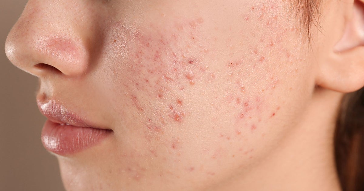 El acné juvenil: por qué tratarlo a tiempo es clave para evitar cicatrices físicas y emocionales