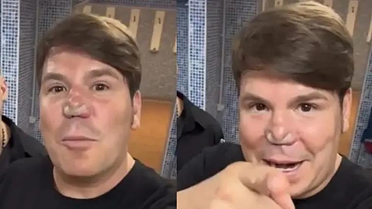 Lucas muestra la tira nasal adhesiva de su nariz