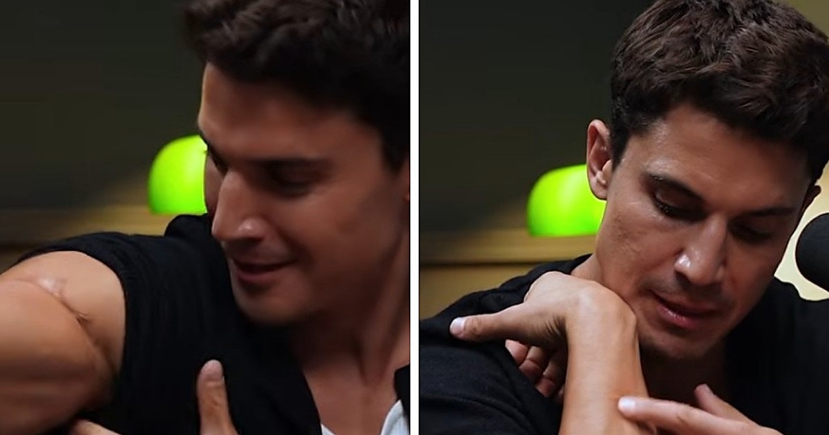 Las cicatrices de Álex González y el accidente que cambió su vida: «Casi pierdo el brazo»