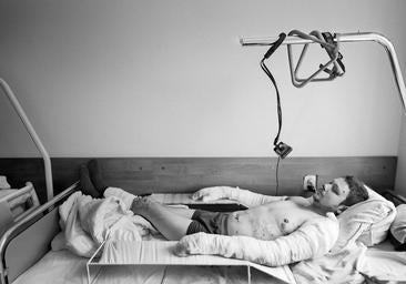 La batalla después de las trincheras: la lucha por la vida de los quemados en la guerra de Ucrania