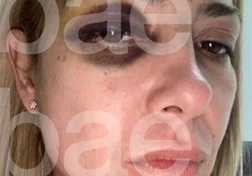 Salen a la luz las imágenes de la expareja de Alberto Fernández con marcas de violencia