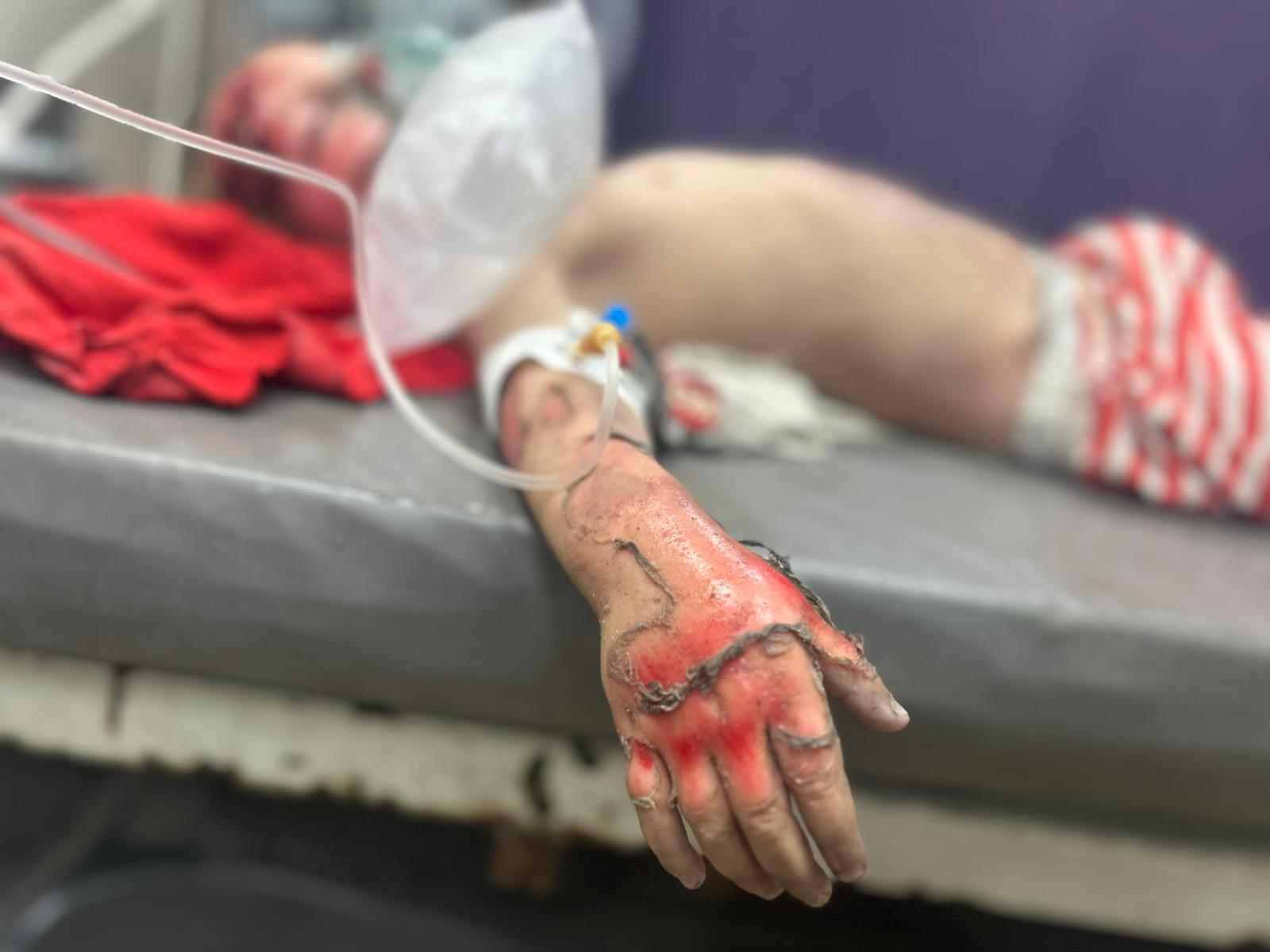 Aseel, de 3 años, es atendida en urgencias después de un bombardeo israelí en Jan Yunis el 25 de mayo de 2025