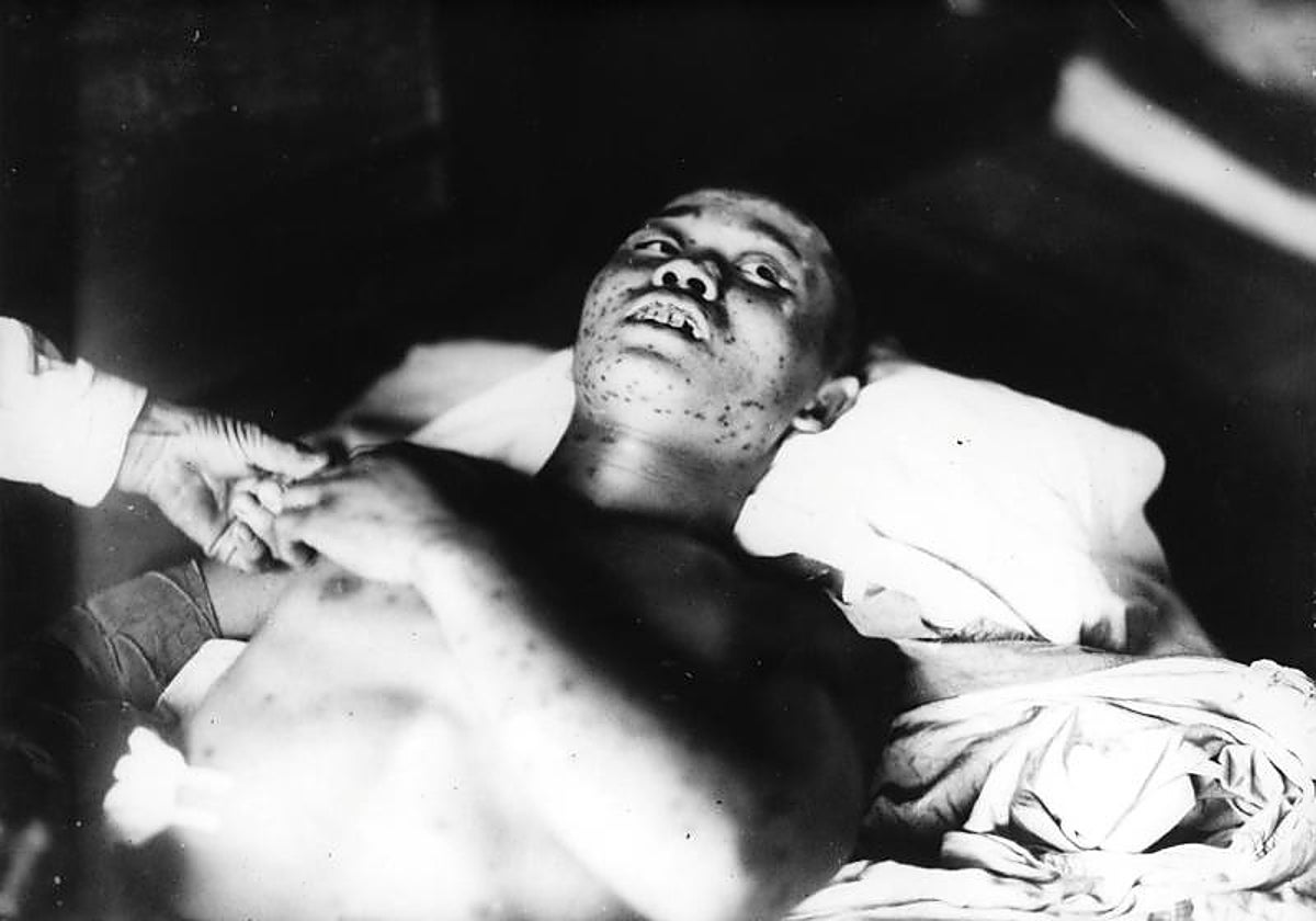 Joven afectado después de la bomba de Hiroshima