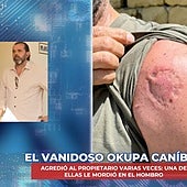 Una «salvajada» de okupación: un 'okupa caníbal' manda al dueño de un piso al hospital de un brutal mordisco
