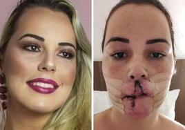Una modelo acaba desfigurada tras una operación de labios con un producto peligroso