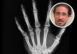 Un fisioterapeuta explica si es bueno crujirse los dedos: «Lo que escuchas no son...»