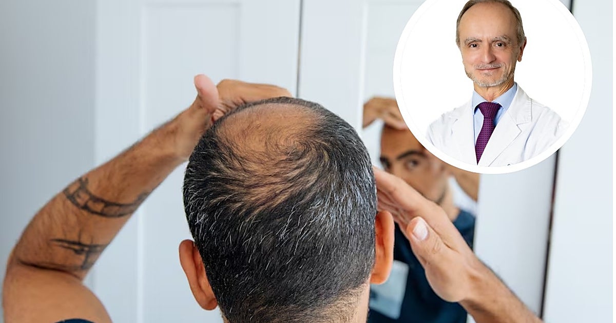 Eduardo López Bran explica por qué España es el país con más calvos del mundo: «Es como muchas otras enfermedades»