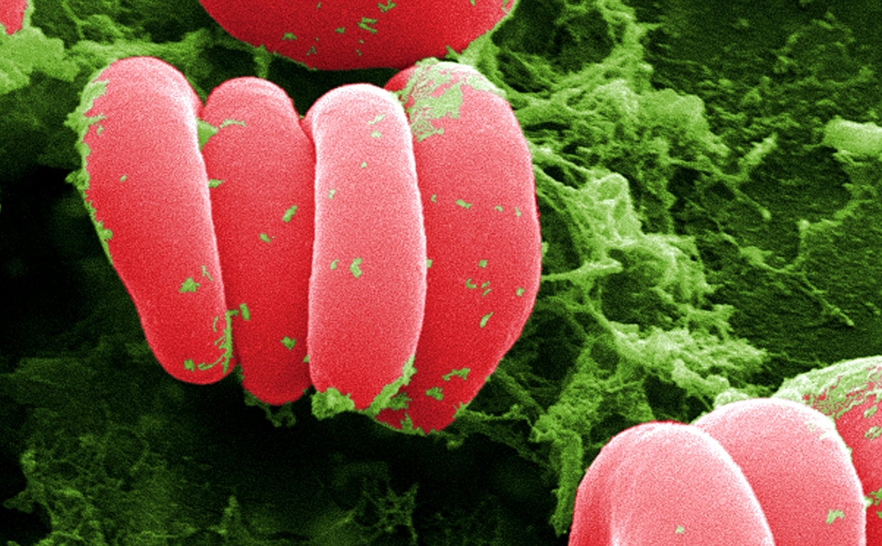 Prueban el intercambio de sangre como terapia para el Alzheimer