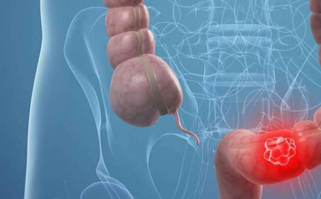 Dostarmilab, ¿posible solución al cáncer de colon?