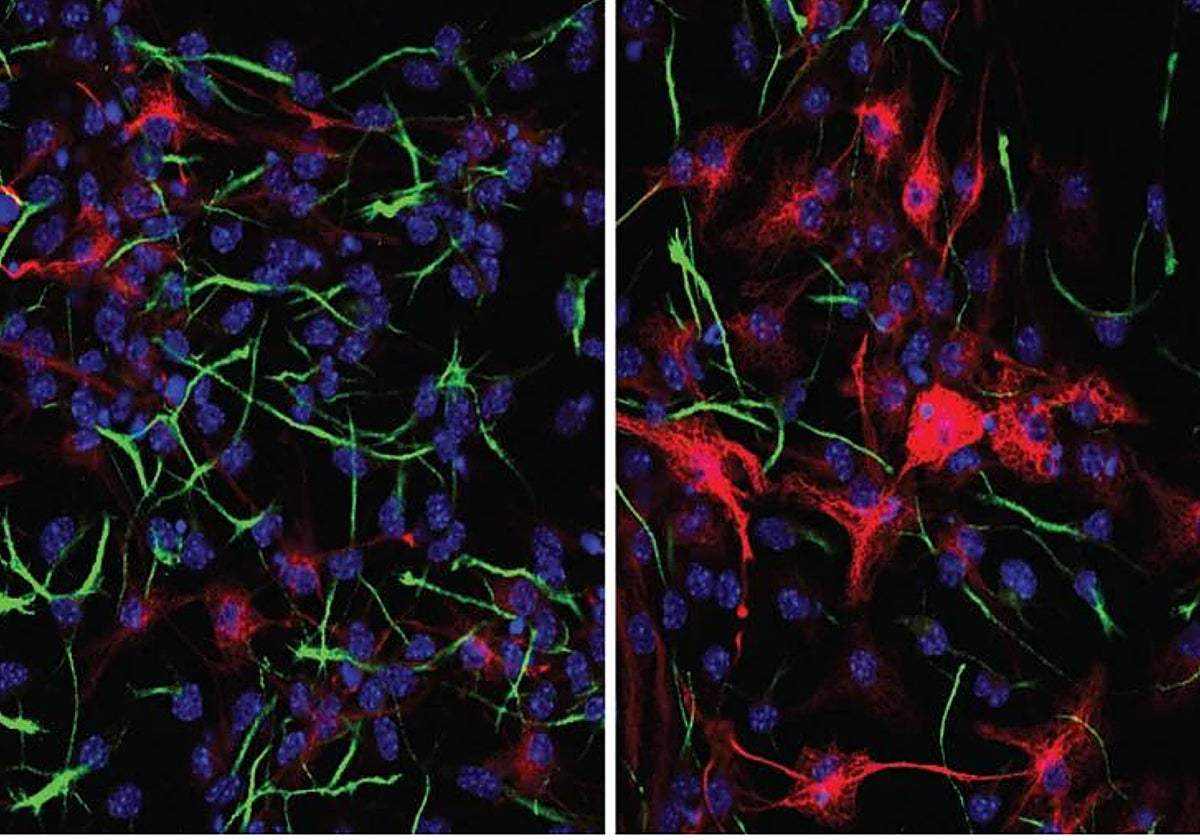 BRD8, el punto débil del cáncer cerebral más mortal