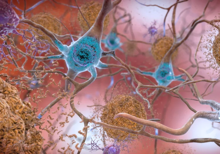 Un estudio vincula las infecciones virales con el alzhéimer y el párkinson