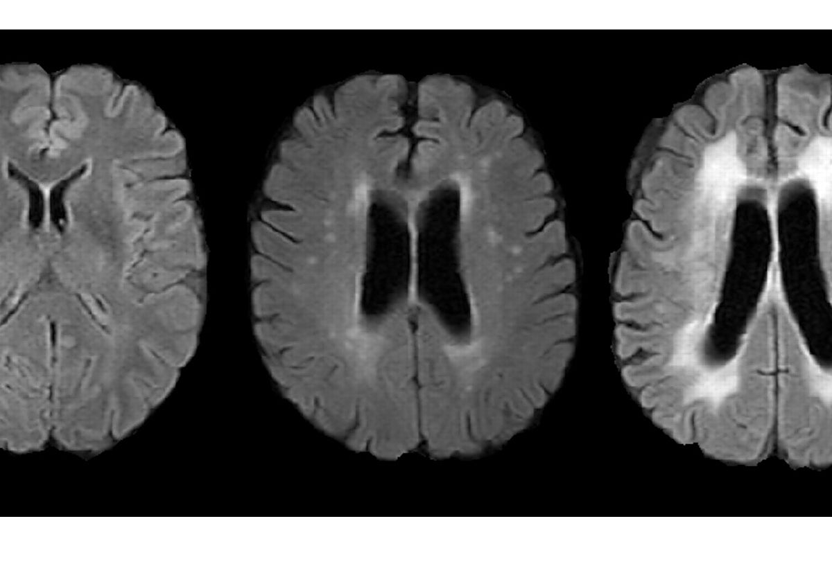 Imagen de resonancia magnética donde se pueden ver hiperintensidades de sustancia blanca, asociadas al grado de envejecimiento cerebral