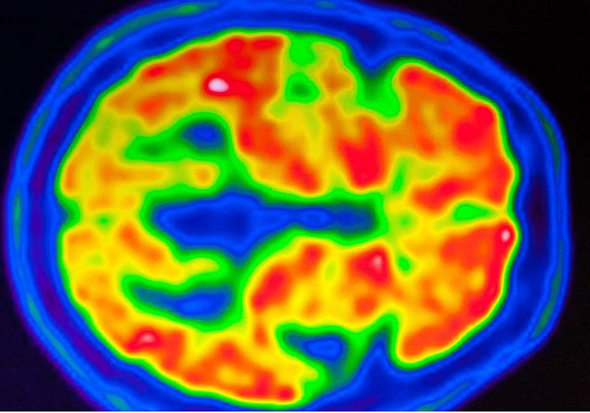 La detección precoz es muy importante en la enfermedad de alzhéimer