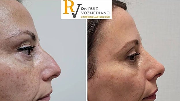 Rinoplastia ultrasónica: ¿por qué es la técnica más demandada?