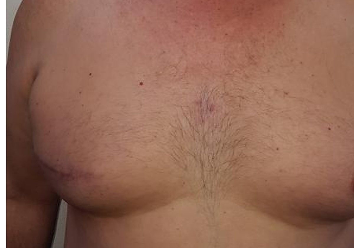 Hombre mastectomizado