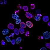 Así engaña el cáncer de mama al sistema inmune para crecer