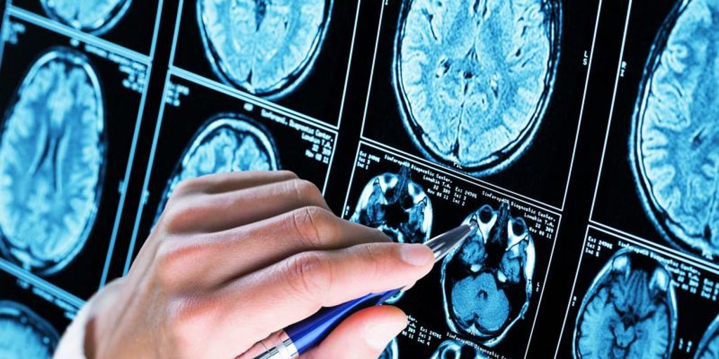 La única variante genética protegida de la enfermedad de Alzheimer
