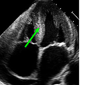 Un equipo español presenta el primer fármaco para el síndrome del corazón rígido
