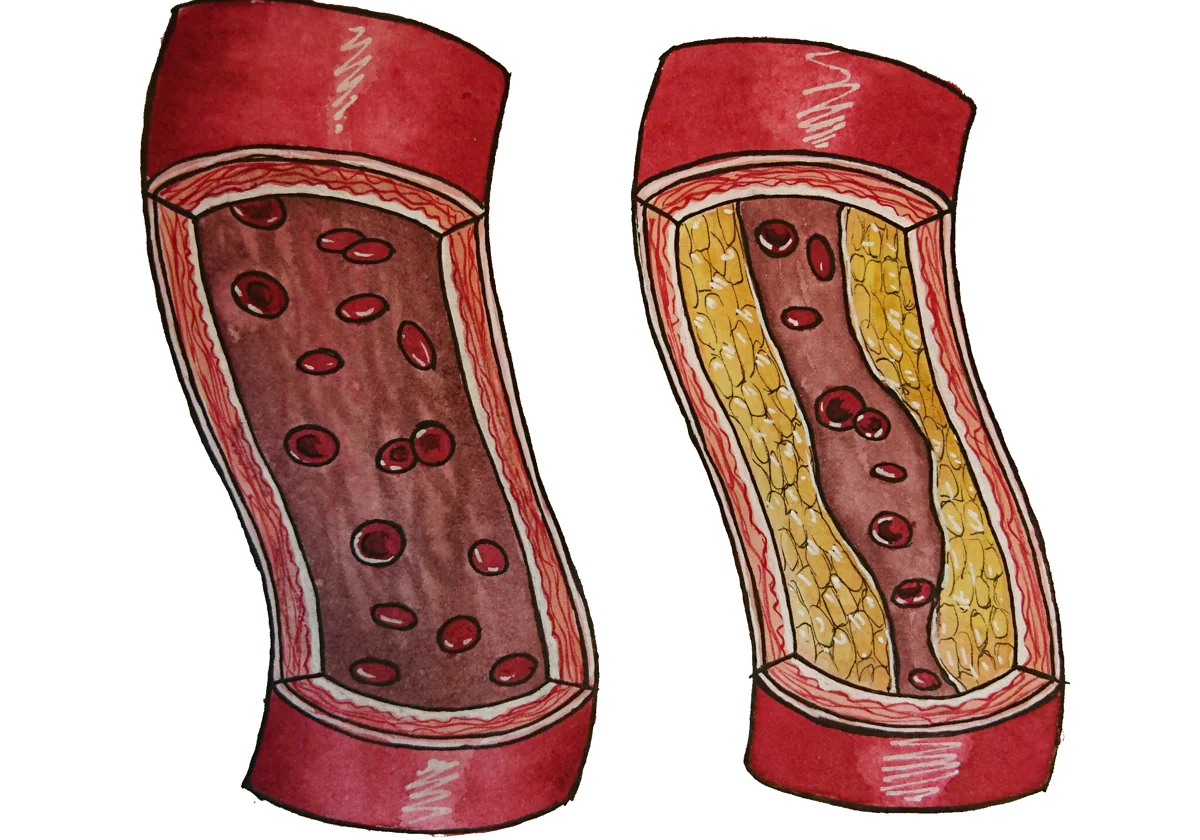 Arterias sanas, a la izquierda, y con aterosclerosis, derecha