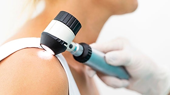Cómo autoexplorarse para detectar el cáncer de piel