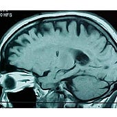 Este estudio cambia el escenario para los tumores cerebrales