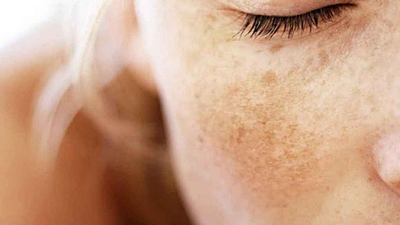 ¿Por qué salen manchas en la cara?